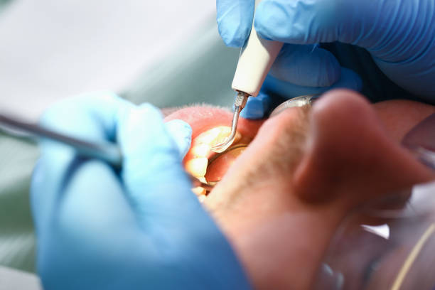 Best Broken or Chipped Tooth Repair in Marysville, WA