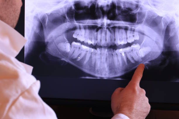 Best Knocked-Out Tooth (Avulsed Tooth) Treatment in Marysville, WA